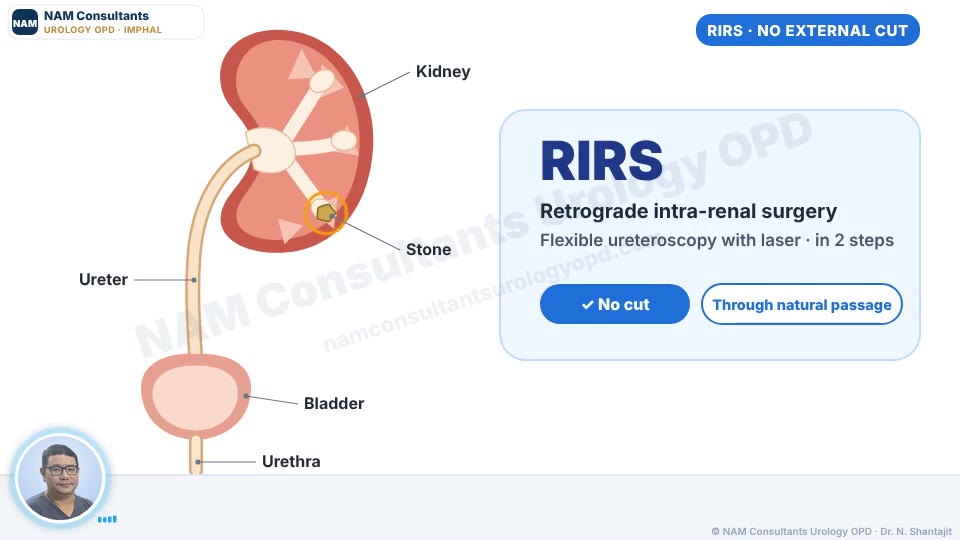 RIRS kidney stone treatment explained