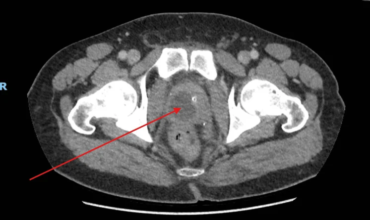 Contrast CT of the pelvis, axial view: a low-density prostate abscess marked with a red arrow